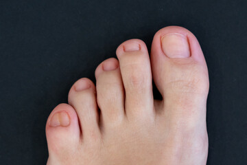 Female feet with big double little toe on black background