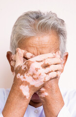 Vitiligo disease on old hand, some part of skin are tanned and the others are white by vitiligo symptoms, caucasian hand.