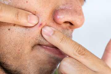 Close up of young man squeezing pimple or acne on his skin. A pimple is a small inflammation or...