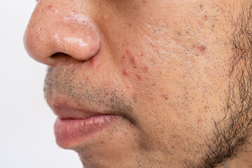 Close up of pores and pimples on men's nose and cheek. Nose pores are openings into the skin, where...