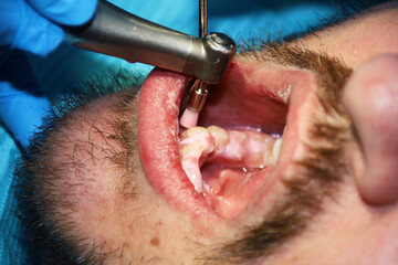 A man with a slight beard undergoing a dental procedure