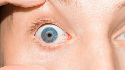 Irritated red bloodshot human eye looking at camera, close-up. Macro photo of blue iris and red...