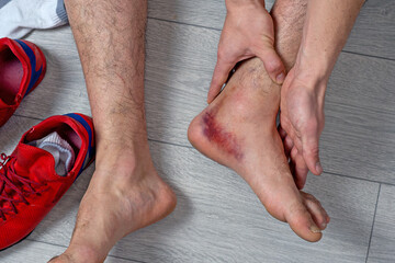 Ankle injury with dislocation and sprains. Fracture or Leg sprain injury of young sports man. 