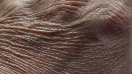 Close Up Of Senior's Hands With Alzheimer Disease