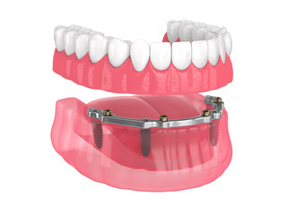Bar retained removable overdenture installation supported by implants