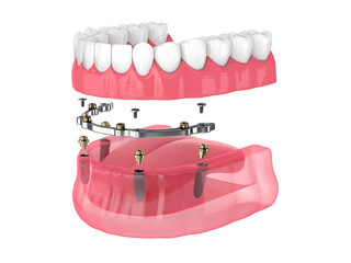 Bar retained removable overdenture installation supported by implants