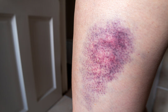Bruise Female Images – Browse 14,580 Stock Photos, Vectors, and