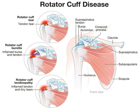 Shoulder Rotator Cuff Disease Illustration. Labeled