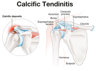 Calcific Tendinitis Shoulder Illustration. Labeled - obrazy, fototapety, plakaty