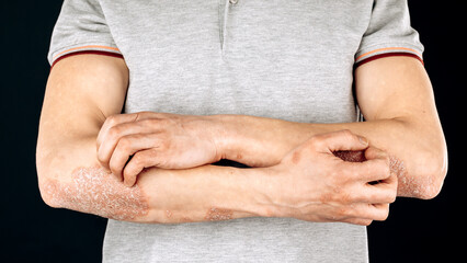 Acute psoriasis on the elbows is an autoimmune incurable dermatological skin disease. A large red,...