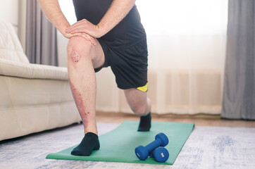 A man does sports exercises at home. There is psoriasis on the leg. - obrazy, fototapety, plakaty