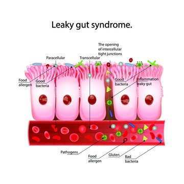 Leaky gut syndrome. Healthy cells and inflamed intestinal cells.Paracellular and  Transcellular transport route.