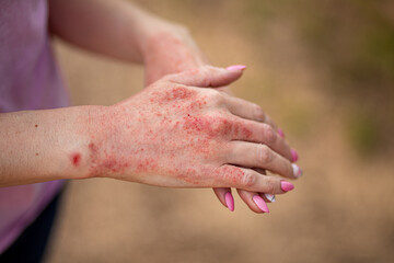 Close up dermatitis on skin, ill allergic rash eczema skin of patient , atopic dermatitis symptom...