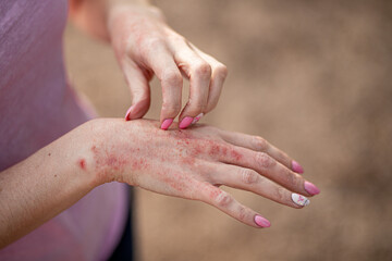 eczema dermatitis on hands and feet. red spots on the skin. dry skinThe concept dermatology,...