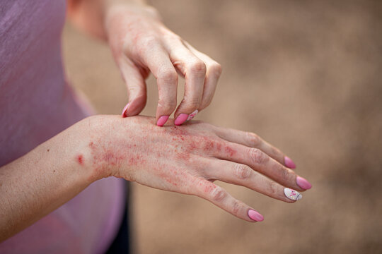 eczema dermatitis on hands and feet. red spots on the skin. dry skinThe concept dermatology, treatment fungal. woman scratching her hand