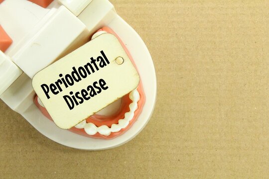 human tooth models and wooden tags with the word periodontal disease