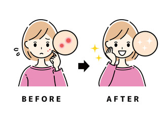 ニキビ　吹き出物　ビフォーアフター