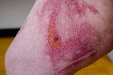 Thermal burn of skin in healing stage. Burnt skin on thigh, domestic injury from boiling water