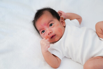 Close up face of newborn baby with atopic eczema on the cheek, concept of healthcare and skin...