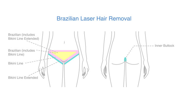 Highlight on woman's body area to do Brazilian laser hair removal treatments. Illustration about diagram for a beauty treatment with laser on the bikini line