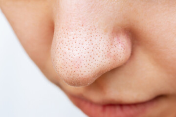 Close-up of a woman's nose with black heads or black dots isolated on a white background. Acne problem, comedones. Enlarged pores on a face. Cosmetology dermatology concept. Blackheads on greasy skin - obrazy, fototapety, plakaty