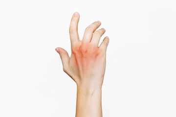 Close-up of a female hand with red rash on the back of the hand isolated on a white background....