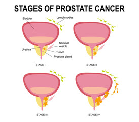 Stages of prostate cancer.Destruction of the male gland with its development into a malignant tumor with impaired reproductive function and blockage of the urethra.Infographics, urology.Medical, flat 