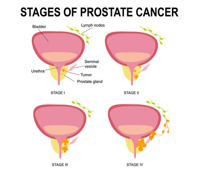 Stages of prostate cancer.Destruction of the male gland with its development into a malignant tumor with impaired reproductive function and blockage of the urethra.Infographics, urology.Medical, flat 
