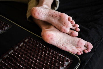 traces from a massager with spikes on the soles of the feet close-up. acupuncture