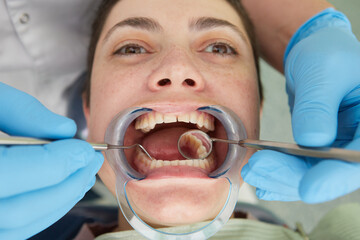Close up of patient with cheek retractor in mouth receiving dental treatment.