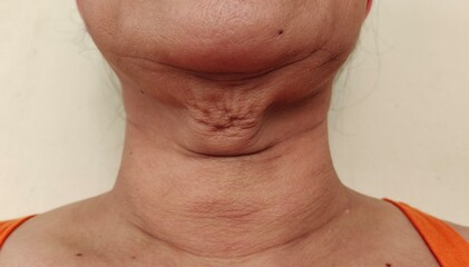 Fototapeta premium Portrait showing the flabbiness adipose hanging under the neck, problem wrinkled under the chin, concept health care.