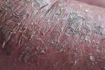 Closeup of cracked and dry skin disease. Medical healthcare concept. Cosmetology dermatology concept.