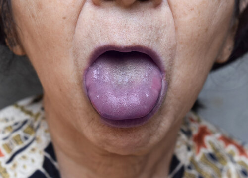 Cyanotic Lips Or Central Cyanosis At Asian, Chinese Old Woman