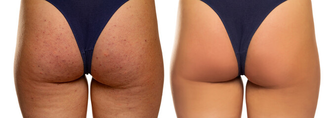 Female buttocks before and after treatment