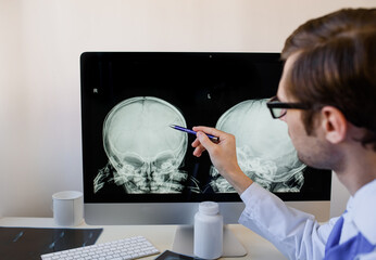 Man radiologist analyzing a child skull x ray with left parietal bone fracture.