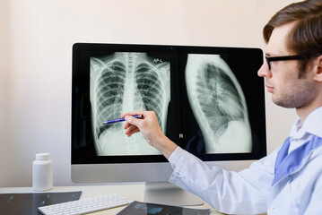 Radiologist analyzing a chest x-ray with pneumonia in right hemithorax lung.