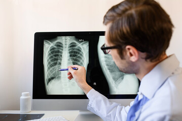 Radiologist analyzing a chest x-ray with pneumonia in right hemithorax lung.