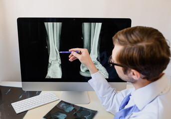 Radiologist analyzing a football player patient x ray with a fibula fracture.