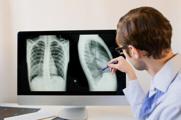 Radiologist analyzing a chest x-ray with pneumonia in right hemithorax lung.