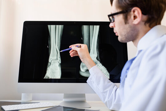 Radiologist analyzing a football player patient x ray with a fibula fracture.