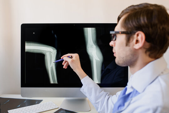 adiologist analyzing a patient child elbow bones x ray with an ulnar fracture and radial luxation.