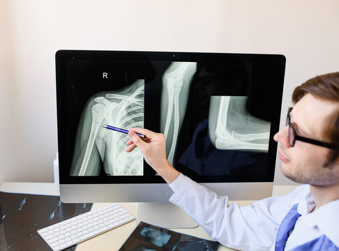 radiologist analyzing a patient arm and forearm bones x ray with a humerus fracture.