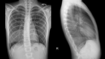 segmental pneumonia in the right hemithorax/lung of a young male patient..