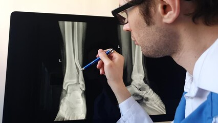 Man radiologist analysing a football player patient x ray with a fibula fracture. - Powered by Adobe