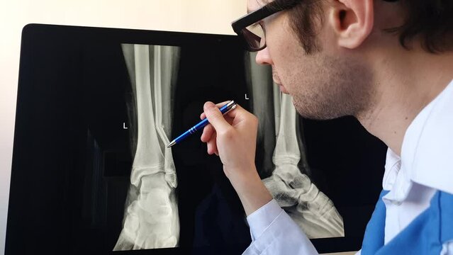 Man radiologist analysing a football player patient x ray with a fibula fracture.