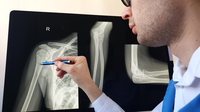 Man radiologist analysing a patient arm and forearm bones x ray with a humerus fracture.
