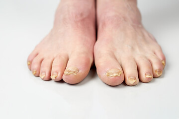 Nail fungus on legs disease. Fungal infection on nails legs, finger with onychomycosis, damage on...