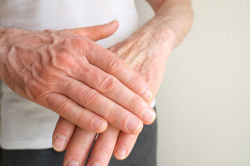 Fototapeta premium Close up of male hands with dry skin damage, applying moisturizer. Dermatology concept human hands with skin with cracks and wounds, skin treatment, aging hand skin care
