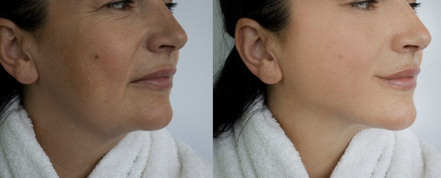 woman face wrinkles before and after treatment