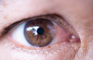 The eyes of people with cataract, a disease of the eye.	